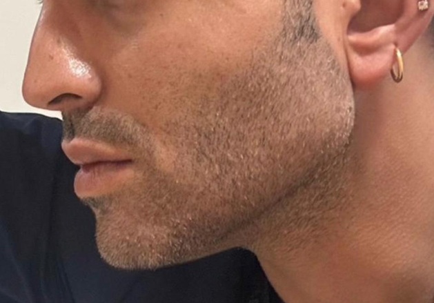 Dopo - Ridefinizione Angolo Mandibolare