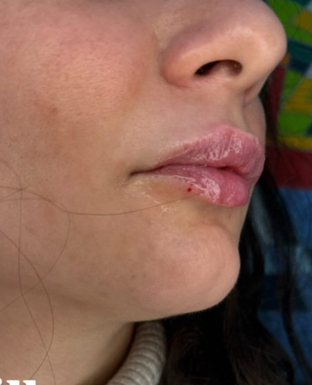 Dopo - LIPFILLER