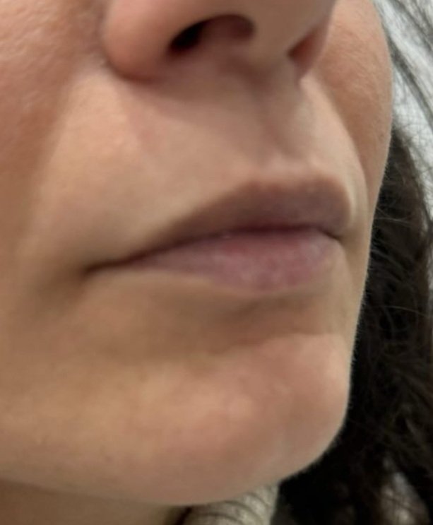 Prima - LIPFILLER