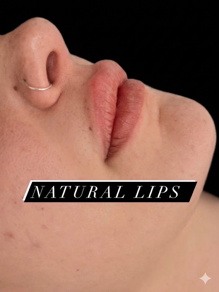 Dopo - LIPFILLER