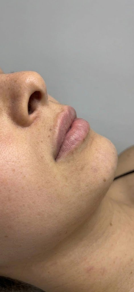 Prima - LIPFILLER