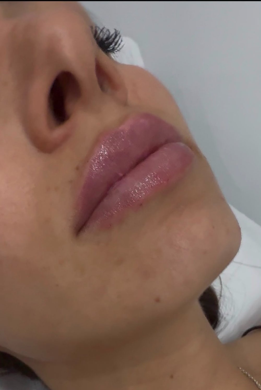 Dopo - LIPFILLER