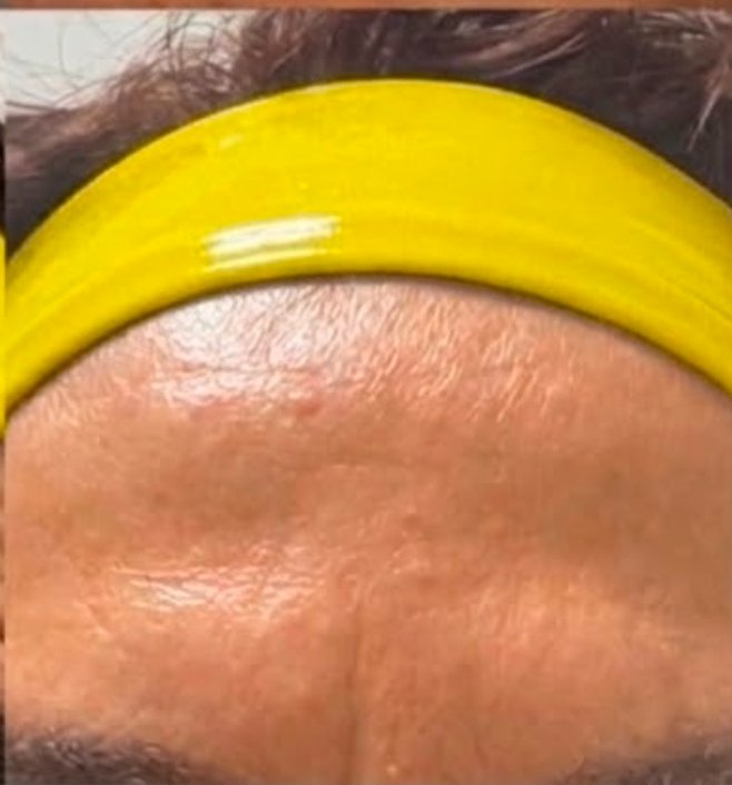 Dopo - BOTOX
