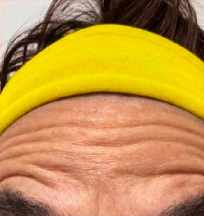 Prima - BOTOX