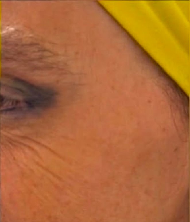 Dopo - BOTOX