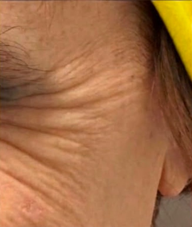 Prima - BOTOX