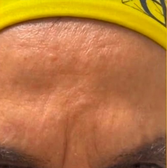 Dopo - BOTOX