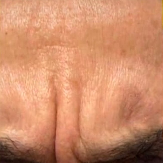 Prima - BOTOX